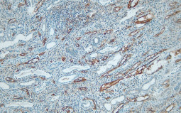 IHC-P obrázky zobrazujúce farbenie protilátky voči c4-d v rejektovanej obličke, DB Biotech