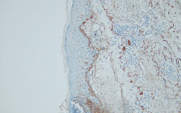 IHC-P obrázky zobrazujúce farbenie protilátky voči c3-d v rejektovanej obličke a bulóznom pemfigolde 2, DB Biotech